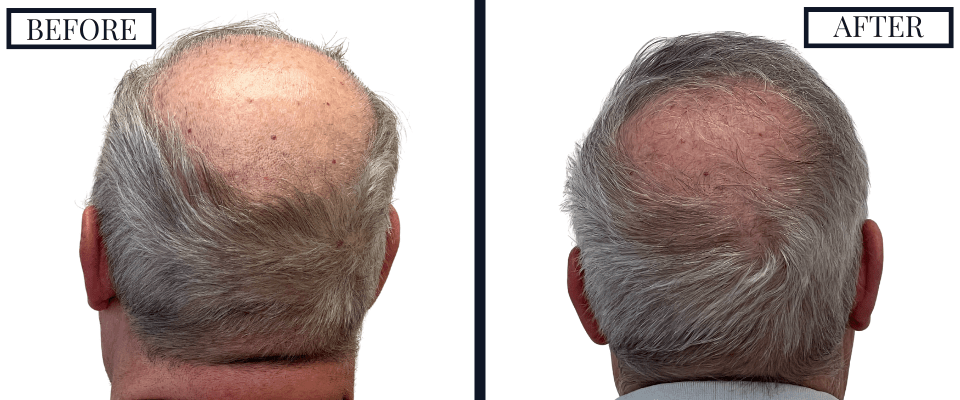 2018 Graft FUE Hair Transplant