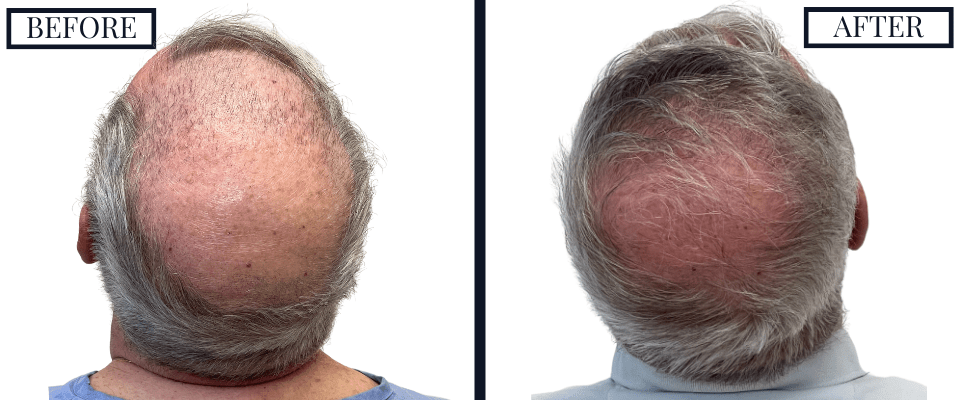 2018 Graft FUE Hair Transplant