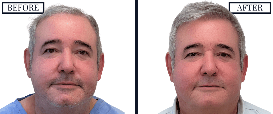 2018 Graft FUE Hair Transplant