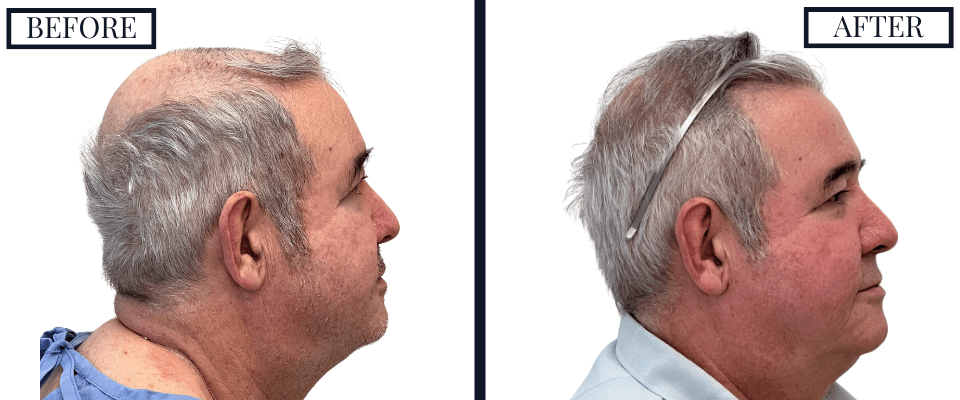 2018 Graft FUE Hair Transplant