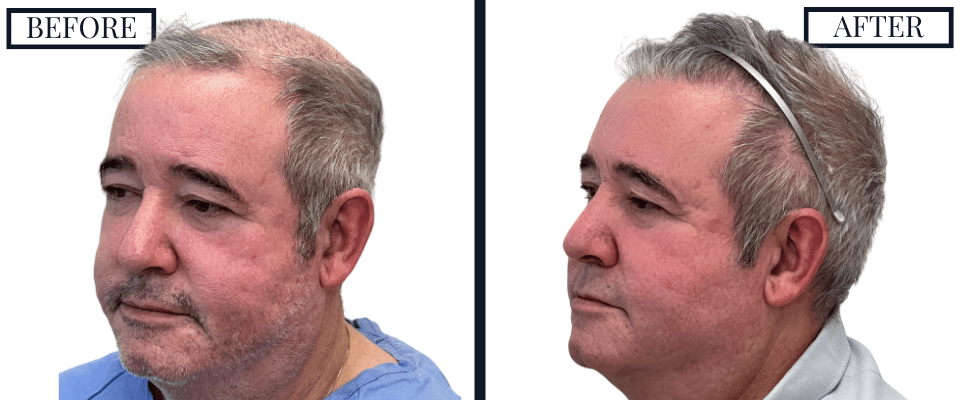 2018 Graft FUE Hair Transplant