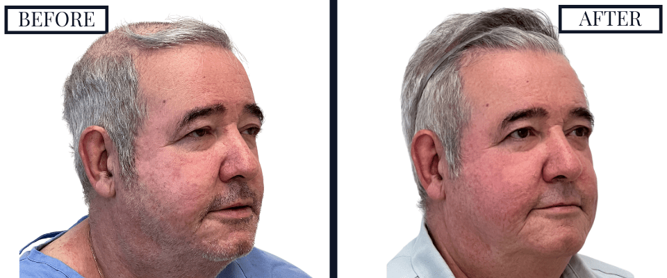 2018 Graft FUE Hair Transplant