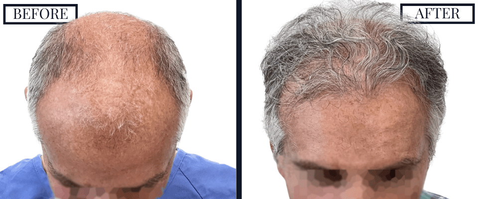 1509 graft fue hair transplant