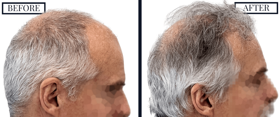 1509 graft fue hair transplant