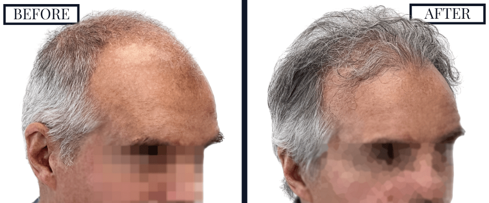 1509 graft fue hair transplant