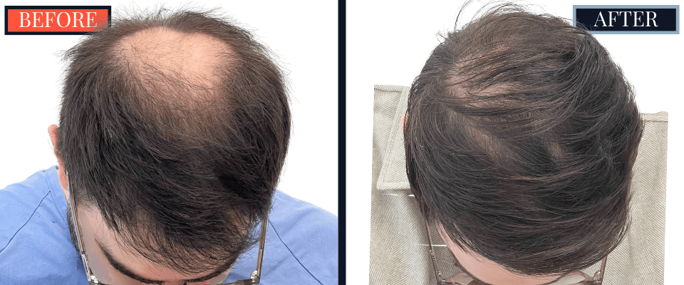2008 GRAFT FUE RESULTS BEFORE AND AFTER