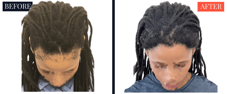 2004 Graft FUT Strip Hair Transplant Before and After - Traction Alopecia