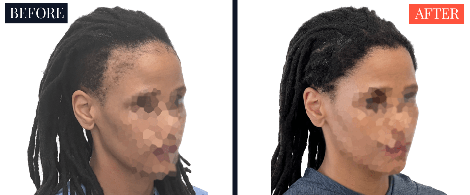 2004 Graft FUT Strip Hair Transplant Before and After - Traction Alopecia
