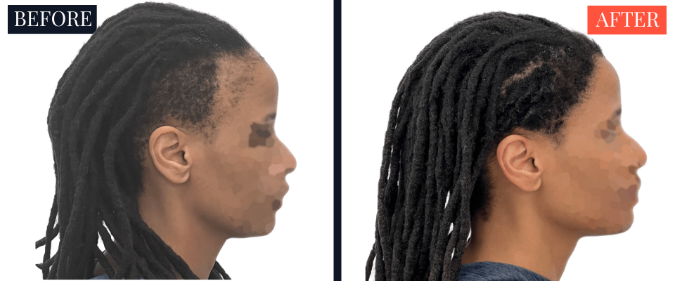 2004 Graft FUT Strip Hair Transplant Before and After - Traction Alopecia