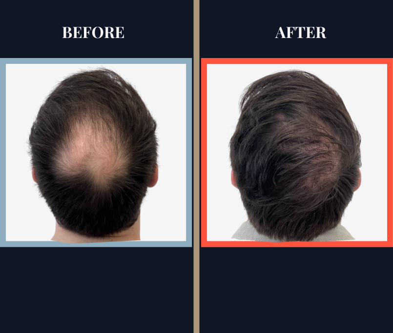 2008 GRAFT FUE RESULTS BEFORE AND AFTER