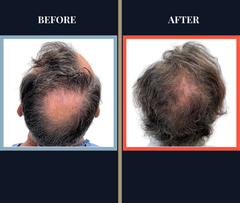2511 GRAFT FUT HAIR TRANSPLANT