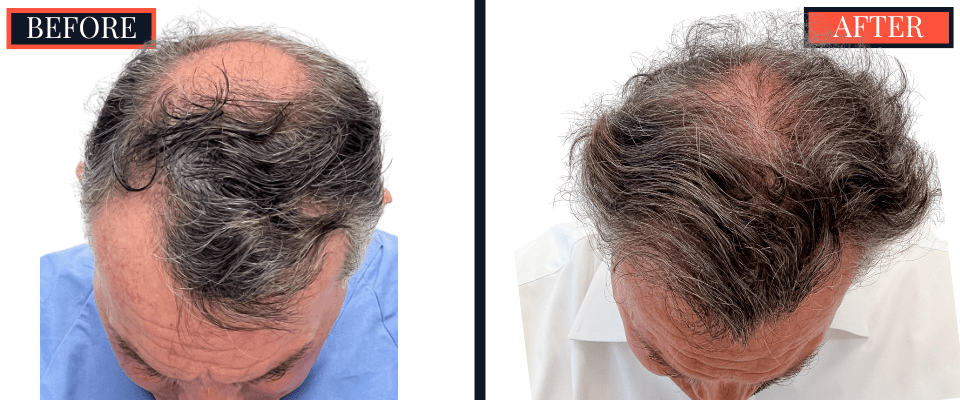 2511 GRAFT FUT HAIR TRANSPLANT