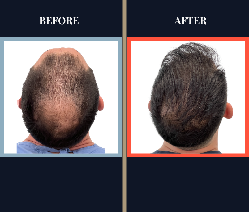3008 GRAFT FUE HAIR TRANSPLANT BEFORE AND AFTER RESULT