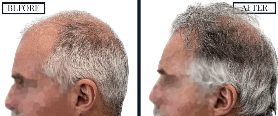 1509 graft fue hair transplant