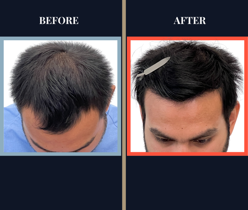 1006 GRAFT FUE HAIR TRANSPLANT - 1 YR POST-OP RESULT