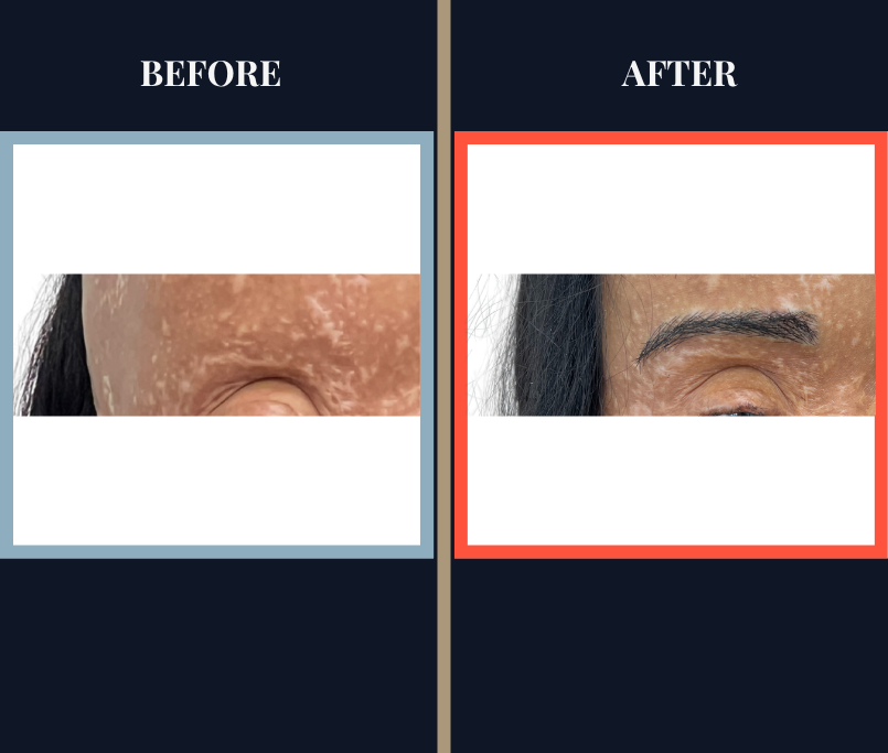 FUT EYEBROW TRANSPLANT