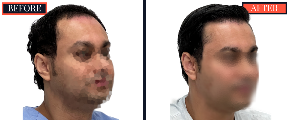 2344 GRAFT FUE BEFORE AND AFTER RESULTS
