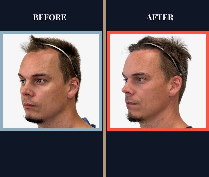 1570 Graft FUE HAIR TRANSPLANT BEFORE AND AFTER RESULT