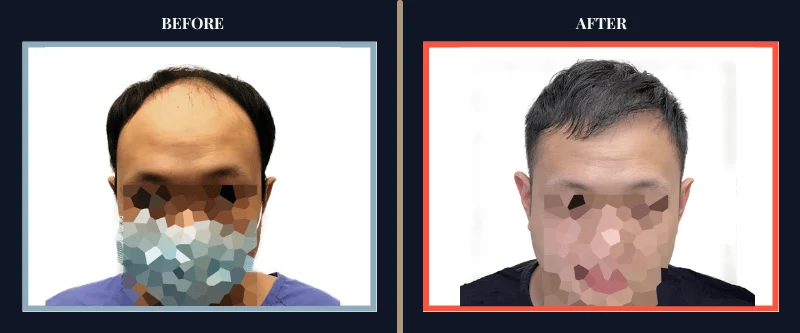 before-after-results-hair-transplant