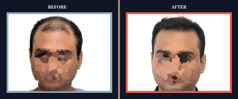 toronto-before-after-results