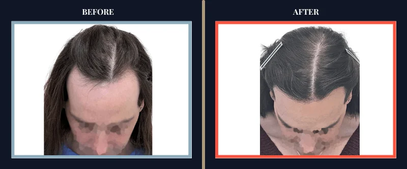 before-after-results-transplant-toronto