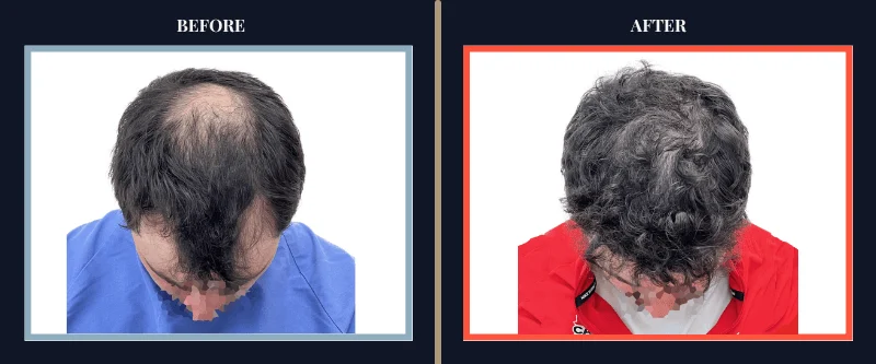 thts-before-after-results