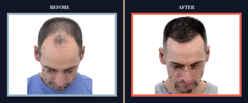 transplant-before-after-results