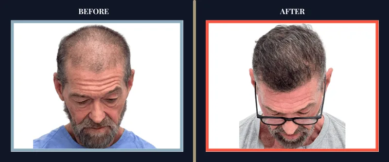 before-after-results-transplant