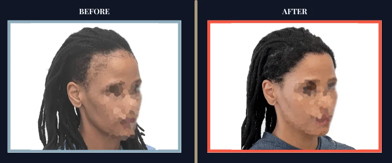 hair-transplant-before-after-results