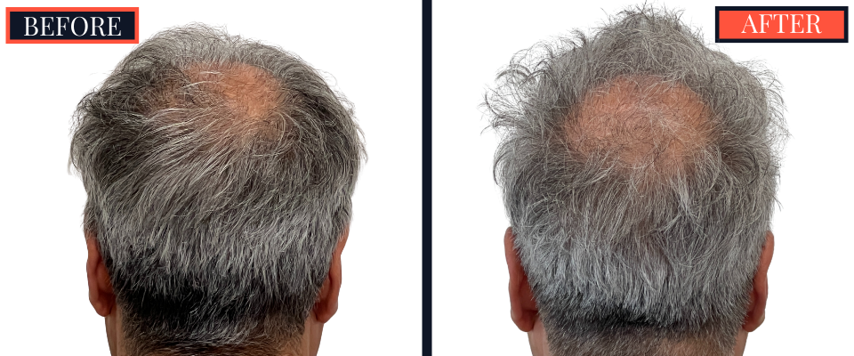 2526 GRAFT FUE HAIR TRANSPLANT - BEFORE AND AFTER