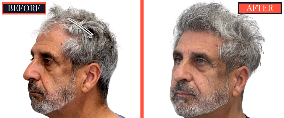 2526 GRAFT FUE HAIR TRANSPLANT - BEFORE AND AFTER
