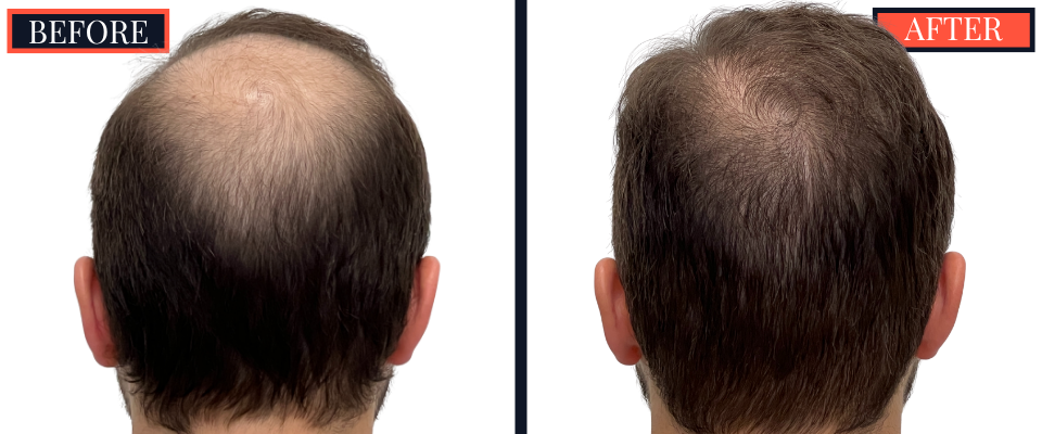 FUE Hair Transplant - 2593 grafts - Before and After Results