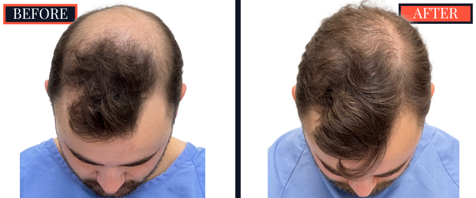 FUE Hair Transplant - 2593 grafts - Before and After Results