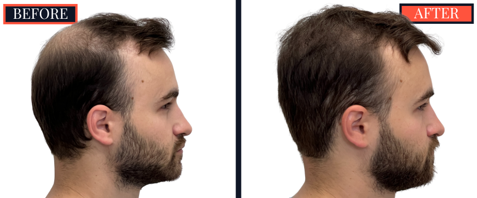 FUE Hair Transplant - 2593 grafts - Before and After Results