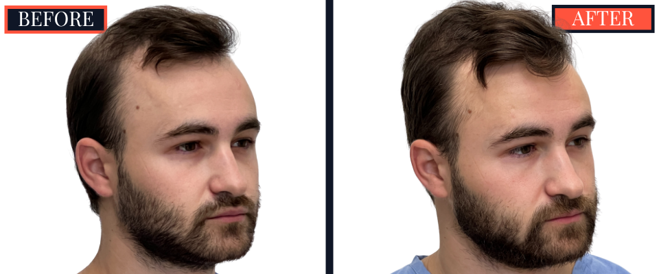 FUE Hair Transplant - 2593 grafts - Before and After Results