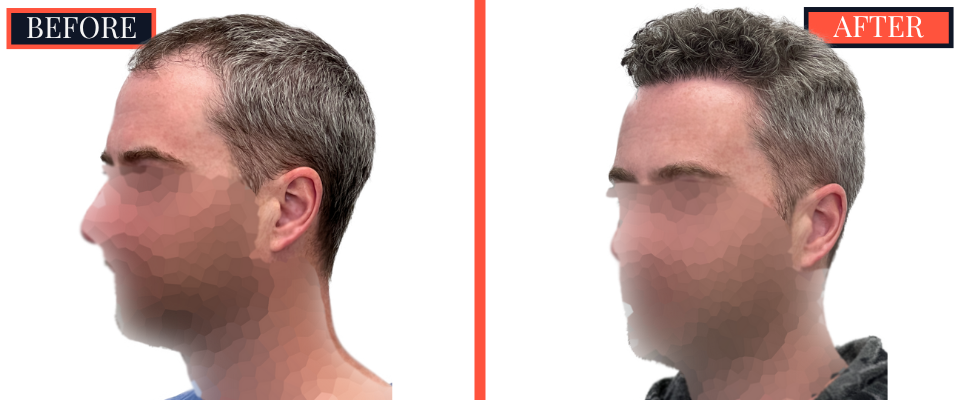 FUE Hair Transplant - 1773 grafts