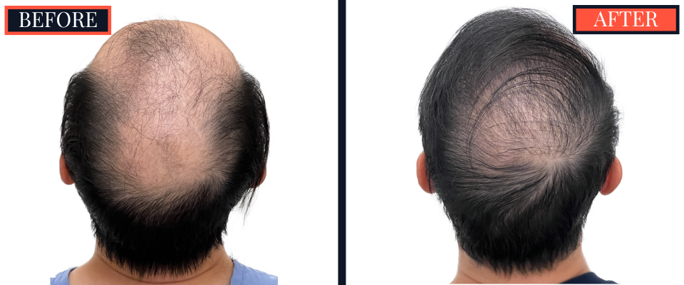 2059 GRAFT FUT/STRIP Hair Transplant