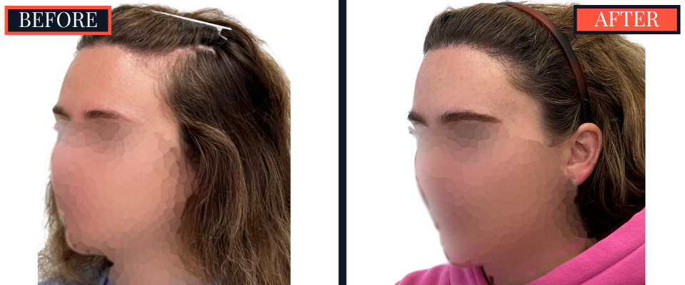 2030 graft fut female hair transplant surgery results
