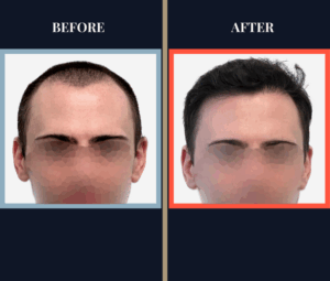 2703 graft FUE hair transplant 1 yr post-op results