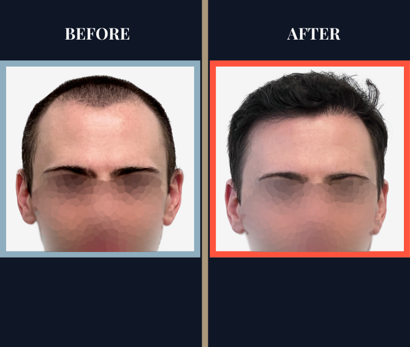 2703 graft FUE hair transplant 1 yr post-op results