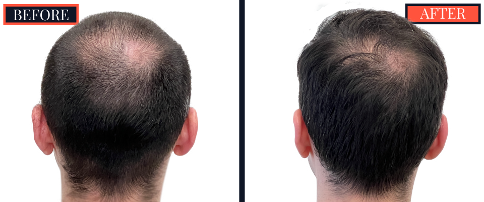 2703 graft FUE hair transplant 1 yr post-op results