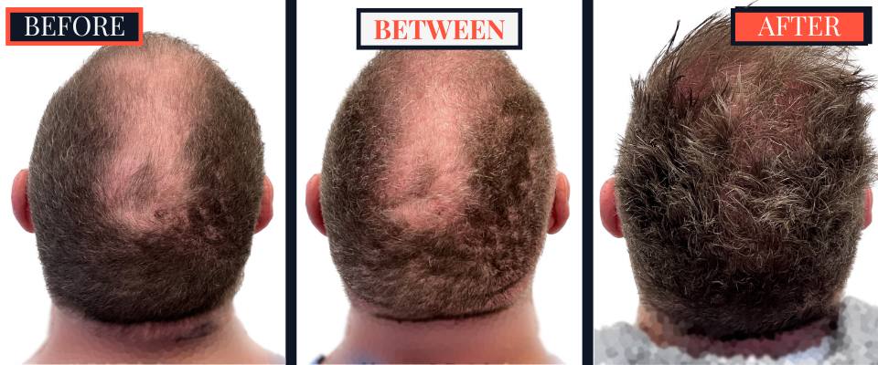 FUE Hair Transplant - Two Surgeries - 3417 grafts
