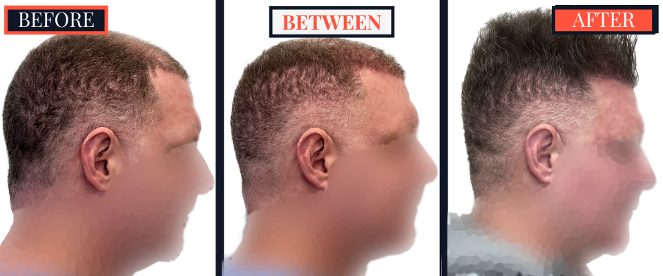 FUE Hair Transplant - Two Surgeries - 3417 grafts