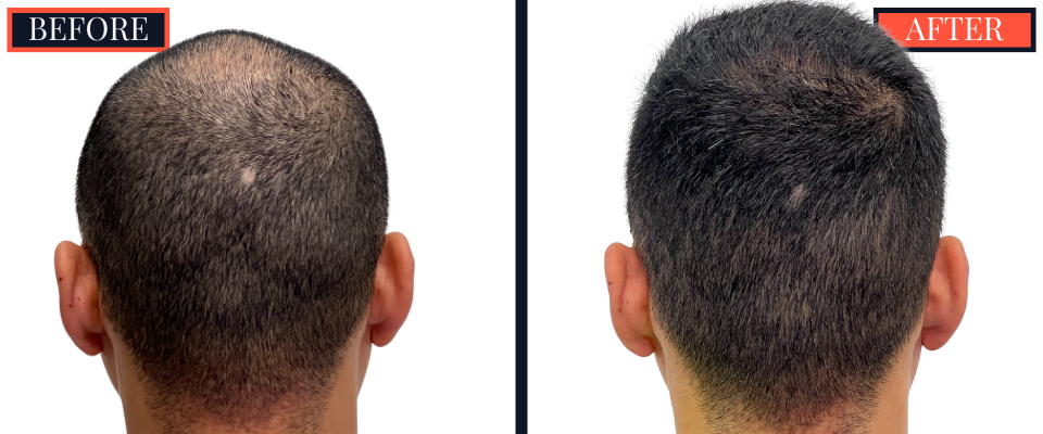 2015 GRAFT FUE HAIR TRANSPLANT RESULTS