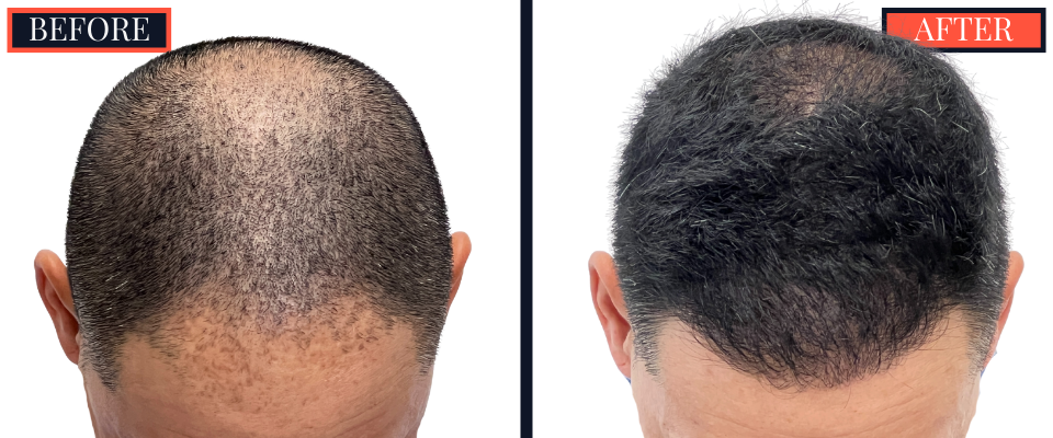 2015 GRAFT FUE HAIR TRANSPLANT RESULTS