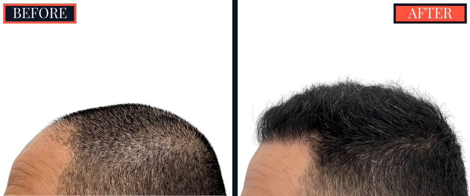 2015 GRAFT FUE HAIR TRANSPLANT RESULTS