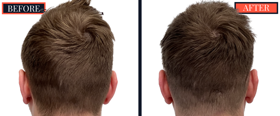 FUE Hair Transplant Results - 1836 Grafts
