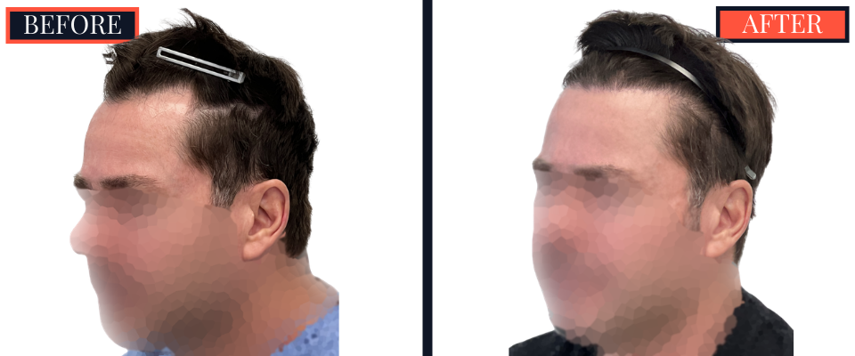THTS Before and After Results - 1206 G FUE