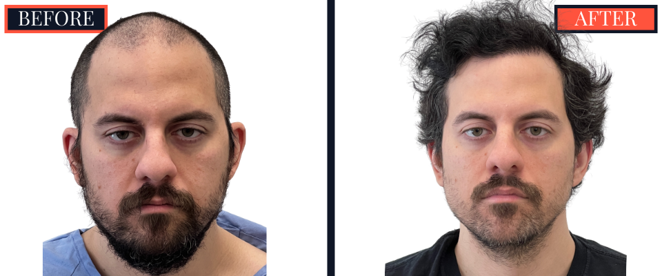 THTS 2051 G FUE Before and After Results