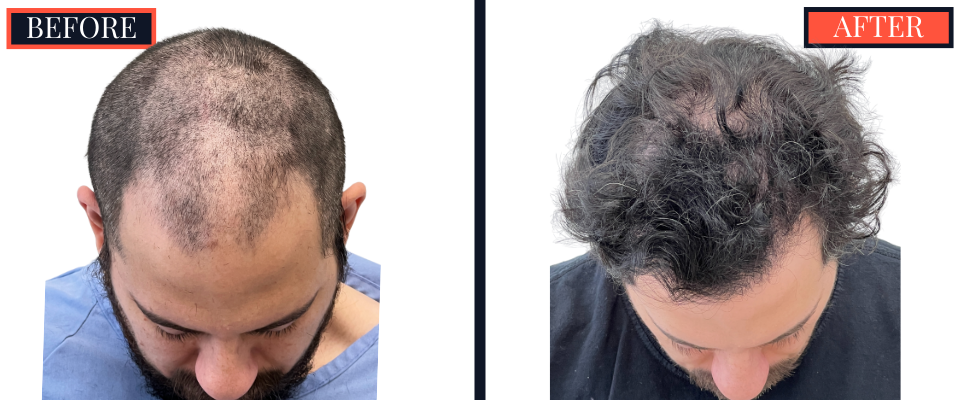 THTS 2051 G FUE Before and After Results